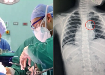 Médicos salvan la vida de un niño de 4 años que ingirió una pila