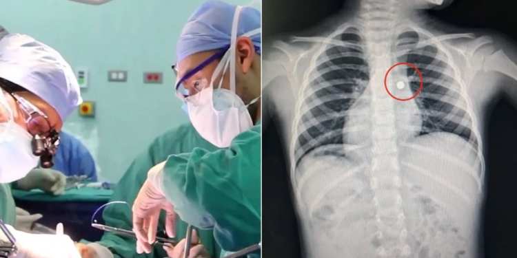 Médicos salvan la vida de un niño de 4 años que ingirió una pila