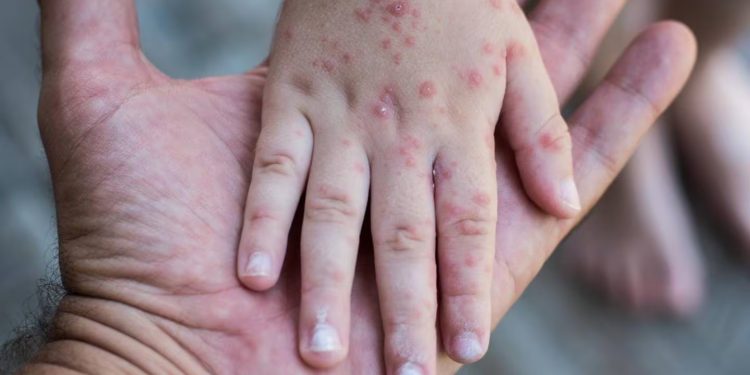 Urgente llamado de la OMS a padres: Vacunen a sus hijos contra el sarampión