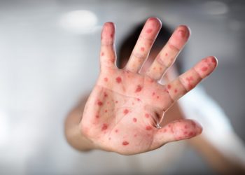 Primer caso de viruela del mono en Piura