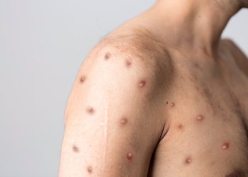 Ica: reportan dos casos de viruela del mono en la provincia