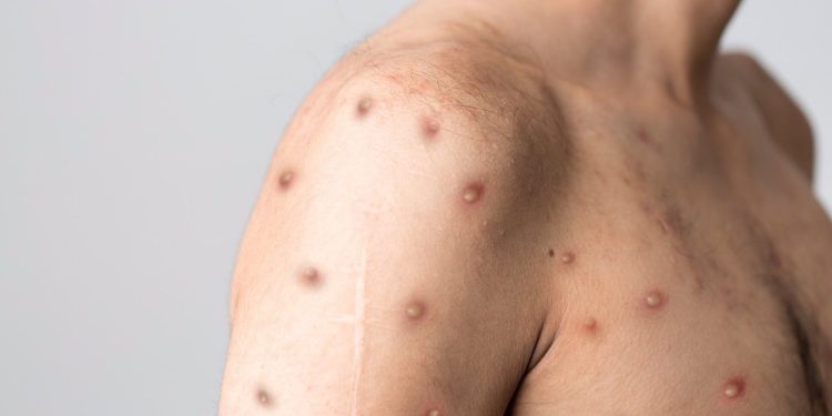 Ica: reportan dos casos de viruela del mono en la provincia