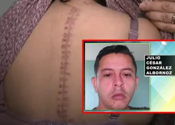 Mujer acaba con 100 puntos tras ser acuchillada por su pareja venezolana