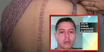 Mujer acaba con 100 puntos tras ser acuchillada por su pareja venezolana