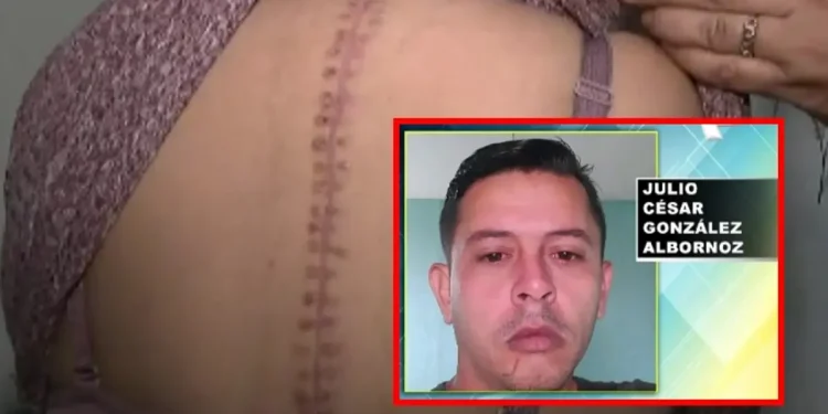 Mujer acaba con 100 puntos tras ser acuchillada por su pareja venezolana