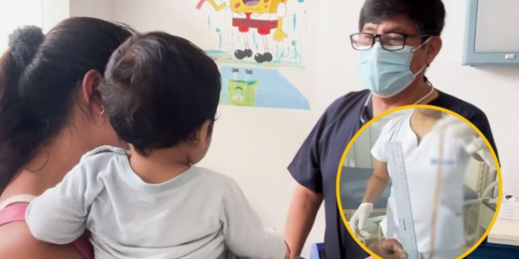 Menor de 2 años expulsó lombriz intestinal de más de 40 centímetros