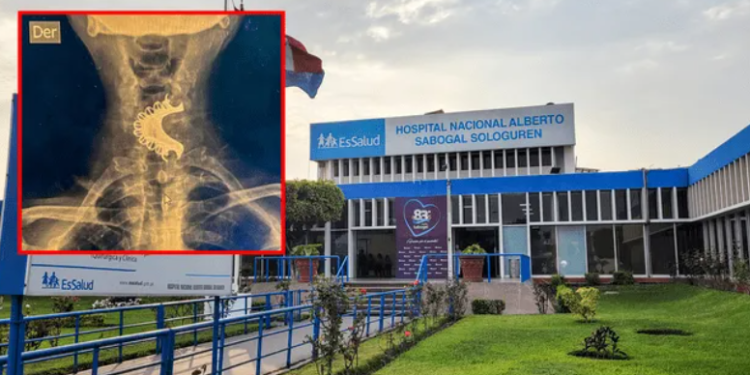 Médicos salvan a adulto mayor que tragó su dentadura postiza