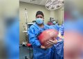 Médicos chalacos extirpan tumor de 25 kilos a jovencita de 22 años