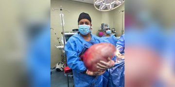 Médicos chalacos extirpan tumor de 25 kilos a jovencita de 22 años