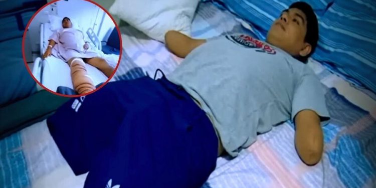 Peruano fue por una operación de rodilla y termina con las 4 extremidades amputadas: habría adquirido una bacteria en clínica
